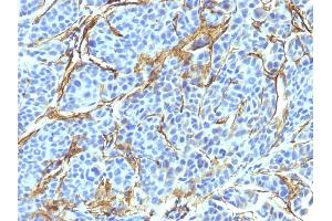 Formalin-fixed, paraffin-embedded human Melanoma stained with NGFR Monoclonal Antibody (NTR/912). (NGFR 抗体)