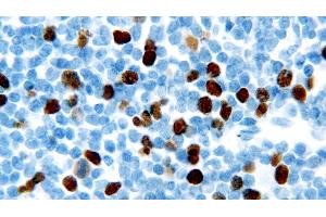 Human chronic lymphocytic leukemia: immunohistochemical staining for Geminin. (Geminin 抗体  (AA 5-209))