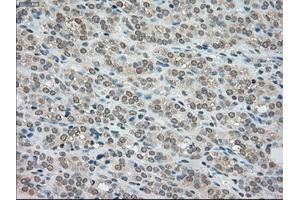 Immunohistochemical staining of paraffin-embedded Carcinoma of kidney tissue using anti-BUB1Bmouse monoclonal antibody. (BUB1B 抗体)