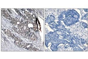 Immunohistochemical analysis of paraffin-embedded human breast carcinoma tissue using p53 (phospho- Ser6) antibody (E011092). (p53 抗体  (pSer6))