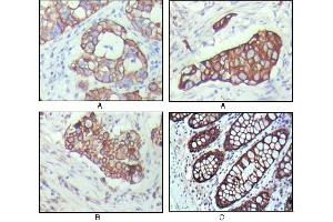 Immunohistochemical analysis of paraffin-embedded human breast carcinoma(A), lung cancer(B) and normal colon tissue(C), showing cytoplasmic localization with DAB staining using KRT19 mouse mAb. (Cytokeratin 19 抗体)