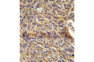 Formalin-fixed and paraffin-embedded human lung carcinoma reacted with DCI Antibody , which was peroxidase-conjugated to the secondary antibody, followed by DAB staining. (DCI 抗体  (C-Term))