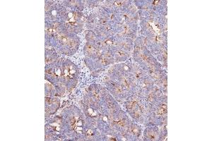 Immunohistochemical analysis of (ABIN387989 and ABIN2845007) on paraffin-embedded Human colon carcinoma tissue was performed on the Leica®BOND RXm. (IFITM3 抗体  (N-Term))