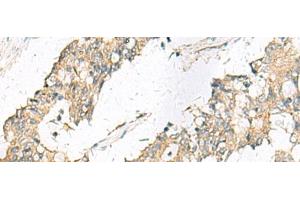 Immunohistochemistry of paraffin-embedded Human colorectal cancer tissue using MGAT4B Polyclonal Antibody at dilution of 1:50(x200) (MGAT4B 抗体)