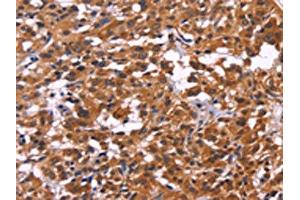 The image on the left is immunohistochemistry of paraffin-embedded Human thyroid cancer tissue using ABIN7130270(MSH4 Antibody) at dilution 1/30, on the right is treated with fusion protein. (MSH4 抗体)