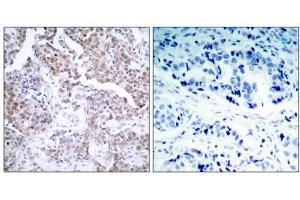 Immunohistochemical analysis of paraffin-embedded human breast carcinoma tissue using p53 (phospho- Ser15) antibody (E011094). (p53 抗体  (pSer15))