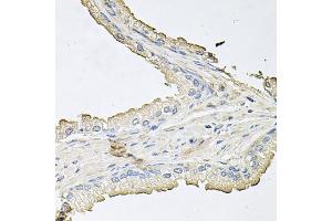 Immunohistochemistry of paraffin-embedded human prostate using AKT1 antibody (ABIN5973219) at dilution of 1/100 (40x lens). (AKT1 抗体)