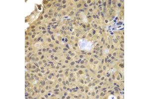 Immunohistochemistry of paraffin-embedded human well-differentiated squamous skin carcinoma using CCNA2 antibody. (Cyclin A 抗体)