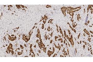 Left: Invasive ductal carcinoma (high expressor): intense nuclear staining in nearly 100 % of tumor cells. (Estrogen Receptor alpha 抗体)