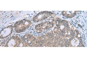 Immunohistochemistry of paraffin-embedded Human gastric cancer tissue using CCNG1 Polyclonal Antibody at dilution of 1:30(x200) (Cyclin G1 抗体)