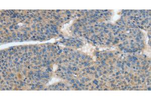 Immunohistochemistry of paraffin-embedded Human liver cancer tissue using ATP4B Polyclonal Antibody at dilution 1:40 (ATP4b 抗体)