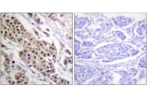 Immunohistochemistry analysis of paraffin-embedded human breast carcinoma, using p53 (Phospho-Ser392) Antibody. (p53 抗体  (pSer392))