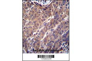 ARL2 Antibody immunohistochemistry analysis in formalin fixed and paraffin embedded human hepatocarcinoma followed by peroxidase conjugation of the secondary antibody and DAB staining. (ARL2 抗体  (C-Term))