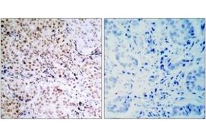 Immunohistochemistry (IHC) image for anti-Retinoblastoma Protein (Rb Protein) (pSer795) antibody (ABIN2888520) (Retinoblastoma Protein (Rb) 抗体  (pSer795))