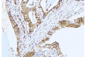 ABIN6275352 at 1/100 staining Human lung cancer tissue by IHC-P. (PEX2 抗体  (Internal Region))