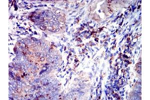 Immunohistochemical analysis of paraffin-embedded rectum cancer tissues using CD53 mouse mAb with DAB staining. (CD53 抗体)