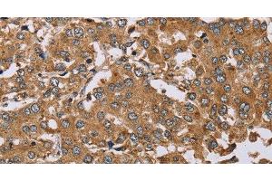 Immunohistochemistry of paraffin-embedded Human liver cancer using DDAH1 Polyclonal Antibody at dilution of 1:50 (DDAH1 抗体)