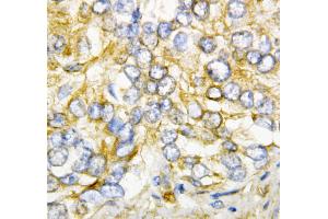 Anti-AIMP2/p38 antibody, IHC(P) IHC(P): Human Rectal Cancer Tissue (AIMP2 抗体  (Middle Region))