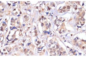 Immunohistochemistry of paraffin-embedded Human breast cancer using STK4 Polyclonal Antibody at dilution of 1:100 (40x lens). (STK4 抗体)