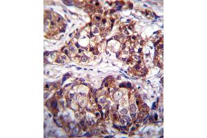 DDR1 Antibody immunohistochemistry analysis in formalin fixed and paraffin embedded human breast carcinoma followed by peroxidase conjugation of the secondary antibody and DAB staining. (DDR1 抗体  (AA 299-330))