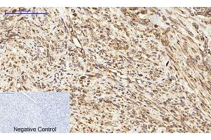 Immunohistochemical analysis of paraffin-embedded human uterus cancer tissue. (Calnexin 抗体)