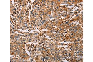 Immunohistochemistry of Human lung cancer using ACTA1 Polyclonal Antibody at dilution of 1:65 (Actin 抗体)