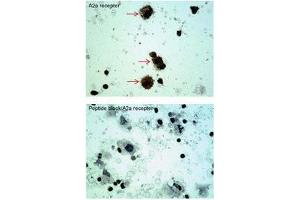 ADORA2A antibody staining of Oral Cell Carcinoma at a dilution of 5 ug/ml (Adenosine A2a Receptor 抗体  (C-Term))