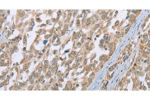 Immunohistochemistry of paraffin-embedded Human esophagus cancer using ECHS1 Polyclonal Antibody at dilution of 1:35 (ECHS1 抗体)