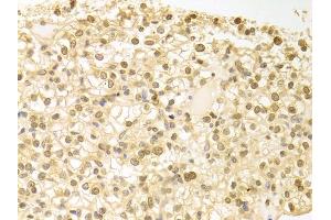 Immunohistochemistry of paraffin-embedded human kidney cancer using PLCB1 antibody (ABIN5971022) at dilution of 1/100 (40x lens). (Phospholipase C beta 1 抗体)