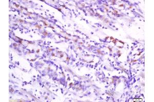 Formalin-fixed and paraffin embedded human stomach carcinoma labeled withAnti-Folate Receptor 4 Polyclonal Antibody, Unconjugated  at 1:200 followed by conjugation to the secondary antibody and DAB staining. (Folate Receptor 4 抗体)