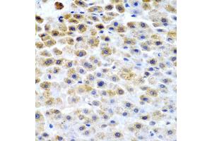 Immunohistochemistry of paraffin-embedded human liver cancer using TFPI2 antibody (ABIN5975010) at dilution of 1/200 (40x lens). (TFPI2 抗体)