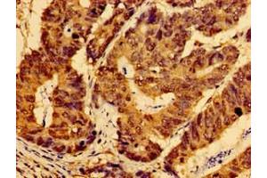 Immunohistochemistry of paraffin-embedded human gastric cancer using ABIN7166644 at dilution of 1:100 (AHSA2P (AA 1-137) 抗体)