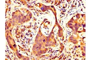 IHC image of ABIN7159063 diluted at 1:500 and staining in paraffin-embedded human pancreatic cancer performed on a Leica BondTM system. (MMP14 抗体  (AA 112-582))