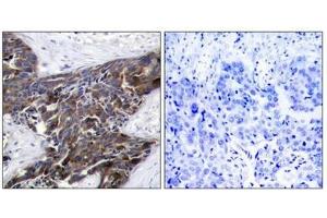 Immunohistochemical analysis of paraffin-embedded human breast carcinoma tissue using Connexin 43(Phospho-Ser367) Antibody(left) or the same antibody preincubated with blocking peptide(right). (Connexin 43/GJA1 抗体  (pSer368))