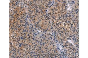 Immunohistochemistry of Human cervical cancer using MAP3K13 Polyclonal Antibody at dilution of 1:40 (MAP3K13 抗体)