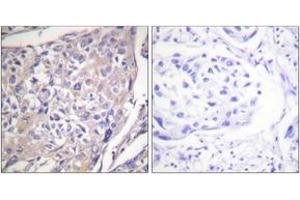 Immunohistochemistry analysis of paraffin-embedded human breast carcinoma, using p70 S6 Kinase (Phospho-Ser418) Antibody. (RPS6KB1 抗体  (pSer418))