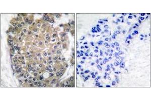 Immunohistochemistry analysis of paraffin-embedded human breast carcinoma tissue, using Keratin 17 Antibody. (KRT17 抗体  (AA 381-430))