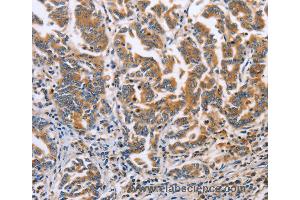 Immunohistochemistry of Human liver cancer using DOK4 Polyclonal Antibody at dilution of 1:60 (DOK4 抗体)