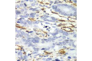 Immunohistochemistry of paraffin-embedded human gastric cancer using CALD1 antibody at dilution of 1:100 (x40 lens). (Caldesmon 抗体)