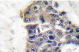 Immunohistochemistry Analysis: AP20200PU-N Synaptotagmin antibody staining of Paraffin-Embedded Human breast carcinoma tissue. (SYT1 抗体)