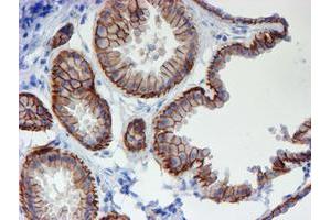 Immunohistochemical staining of paraffin-embedded Human breast tissue using anti-ERBB2 mouse monoclonal antibody. (ErbB2/Her2 抗体  (AA 676-1255))