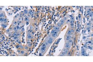 Immunohistochemistry of paraffin-embedded Human gastric cancer using CD54 Polyclonal Antibody at dilution of 1:30 (ICAM1 抗体)