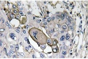 Immunohistochemistry analysis of AQP5 Antibody in paraffin-embedded human lung carcinoma tissue. (Aquaporin 5 抗体)