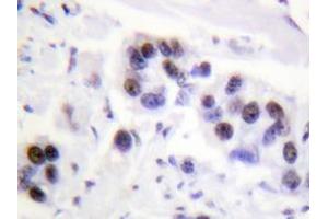 Immunohistochemistry analyzes of Histone H4 antibody in paraffin-embedded human breast carcinoma tissue. (Histone H4 抗体)