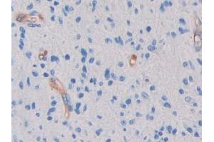 Detection of GC in Human Glioma Tissue using Polyclonal Antibody to Glycocalicin (GC) (Glycocalicin 抗体  (AA 136-276))