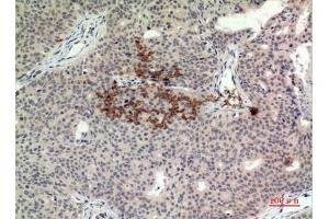 Immunohistochemical analysis of paraffin-embedded human-Breast-cancer, antibody was diluted at 1:100. (STING/TMEM173 抗体  (C-Term))