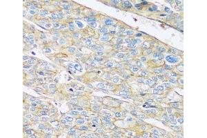 Immunohistochemistry of paraffin-embedded Human liver cancer using ARL4A Polyclonal Antibody at dilution of 1:100 (40x lens). (ARL4A 抗体)
