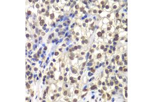 Immunohistochemistry of paraffin-embedded human kidney cancer using CENPC antibody (ABIN5973936) at dilution of 1/200 (40x lens). (Centromere Protein C Pseudogene 1 (CENPCP1) 抗体)