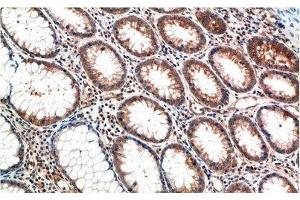 Immunohistochemistry of paraffin-embedded Human colon carcinoma tissue using ATM Monoclonal Antibody at dilution of 1:200. (ATM 抗体)