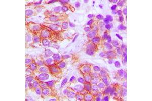 Immunohistochemical analysis of Frizzled 5 staining in human breast cancer formalin fixed paraffin embedded tissue section. (FZD5 抗体  (C-Term))